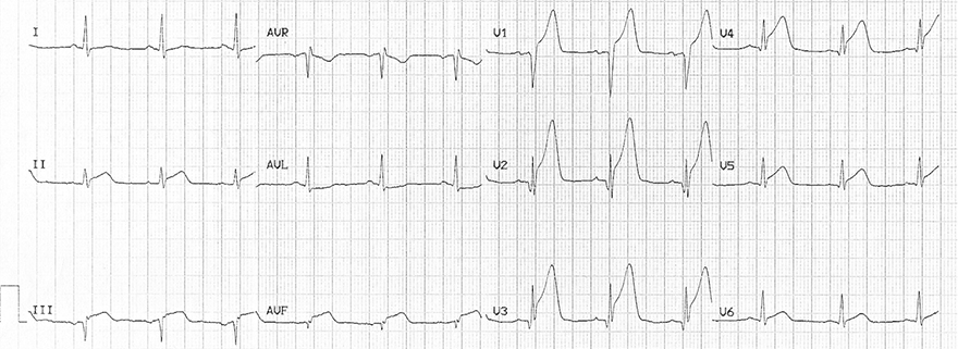 ECG hyperacute T waves and acute anterior inferior STEMI infarction