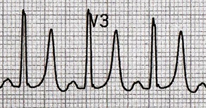 ECG hyperkalemia and Eiffel tower T waves