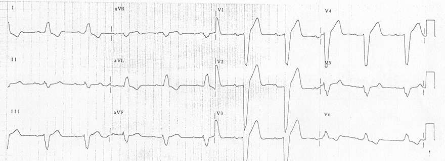 ECG inverted T wave and left bundle branch block (LBBB)