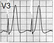 ECG hyperacute T wave and myocardial ischaemia and infarction