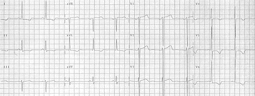 ECG left ventricular hypertrophy and inverted T wave