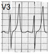 ECG tall narrow symmetrically peaked T wave as Eiffel tower, hyperkalaemia, hyperkalemia