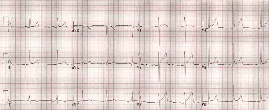 ECG tall t waves and benign early repolarisation, fish hook patter