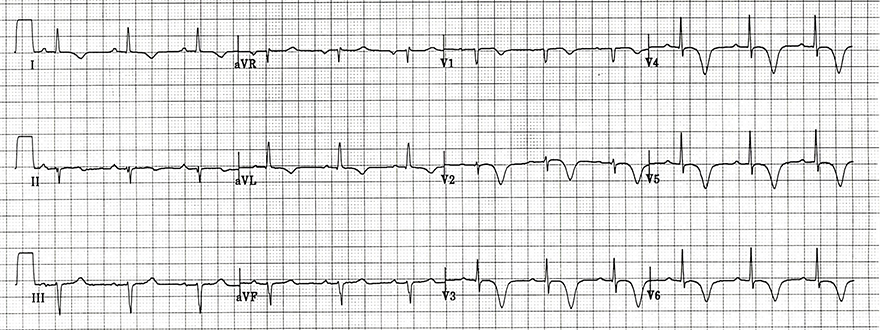 ECG inverted T wave and wellens syndrome type I