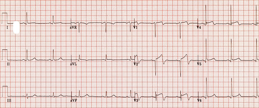 ECG biphasic terminal negative T waves and Wellens syndrome type II