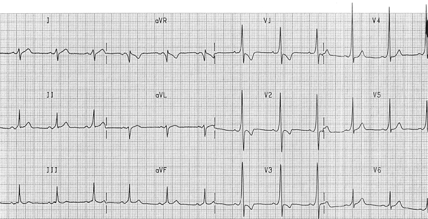 ECG inverted T wave and WPW syndrome type A - left-sided accessory pathway (Bundle of Kent)