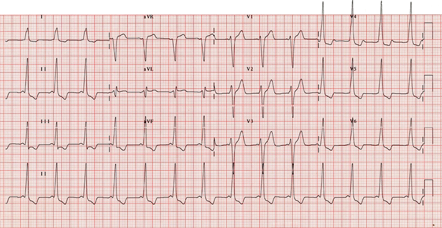 ECG inverted T wave and WPW syndrome type B - right-sided accessory pathway (Bundle of Kent)