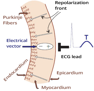 T wave and Myocardial wall repolarization from epicardium to endocardium