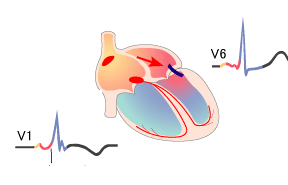 WPW syndrome type A, left-sided accessory pathway (Bundle of Kent)