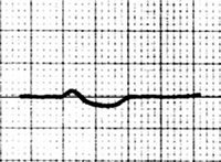 ECG negative Ta wave