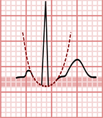 ECG Ta wave amplitude, atrial repolarization