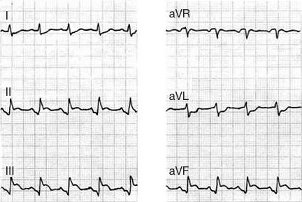 ECG atrial ischaemia infarction and inferior infarction STEMI