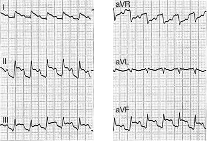 ECG right atrial and inferior ventricular STEMI infarction. 