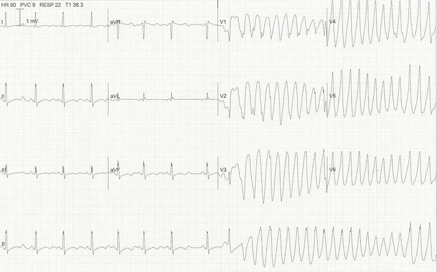 ECG prominent U wave hypokalaemia, hypomagnesemia, Torsades de Pointes