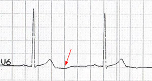 ECG inverted, negative, inversion U wave