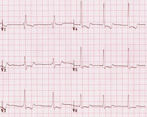 ECG prominent U wave digoxin side effects