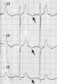 ECG inverted U wave and unstable angina pectoris, ischemia