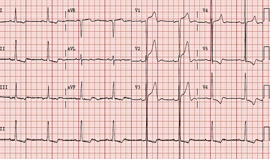 ECG U wave and left ventricular hypertrophy, Sokolow Lyon index
