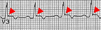 ECG V1 epsilon wave Arrhythmogenic Right Ventricular Disease