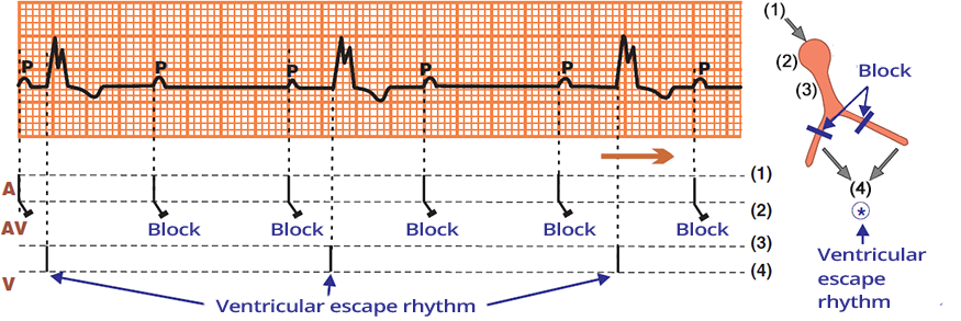 ECG (Ladder diagram - Laddergarm) 3rd degree AV block (complete heart block) variable PQ (PR interval), AV dissociation