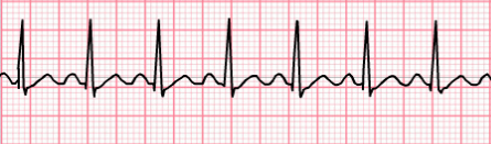 ECG short PQ (PR) interval with sinus tachycardia