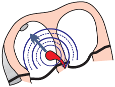 AV node depolarization (activation) and accelerated junctional rhythm