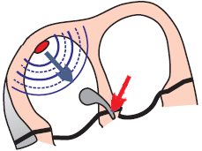 Lown Ganong Levine syndrome with short PQ (PR) interval