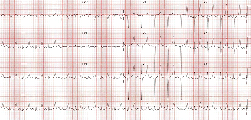 ECG hyperkalemia potassium level 7mEq/l, tall T waves