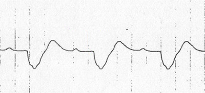 ECG hyperkalemia, prolonged QRS complex, AV block, sine wave