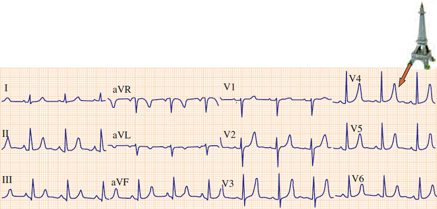 ECG hyperkalemia eiffel tower, peaked T waves, potassium level 6,5 mEq/L