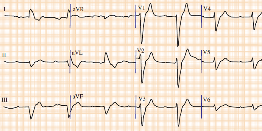 ECG hyperkalemia 7,3 mEq/L, peaked T waves, first degree AV block, broad QRS, flattened T waves