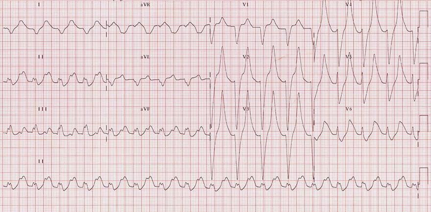 ECG hyperkalemia potassium level 9,2 mEq/L, peaked T waves, broad QRS complexes, sine wave