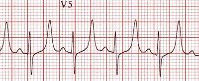 ECG hyperkalemia, peaked T waves, Eiffel Tower