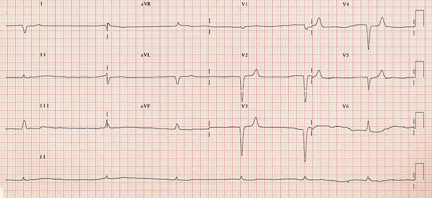 ECG potassium level 7 mEq/L, peaked T waves, Eiffel tower, bradycardia, junctional rhythm