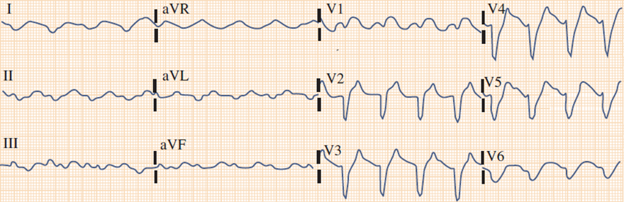 ECG pseudoinfarction pattern Due to hyperkalemia, ST elevation