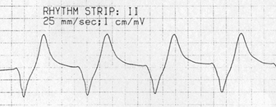 ECG sine wave, hyperkalemia, pre-terminal rhythm