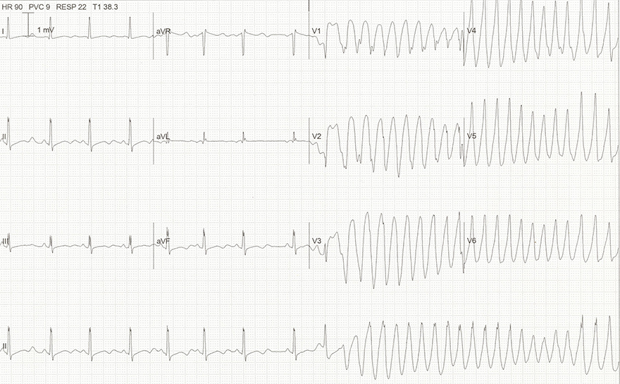 ECG hypokalemia and life threatening ventricular arrhytmia Torsades de Pointes (TdP) with phenomenon r on t