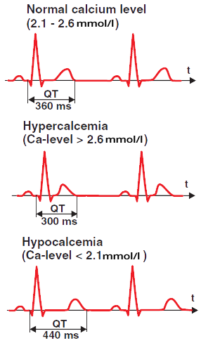 ECG changes in hypercalcaemia, hypocalcaemia