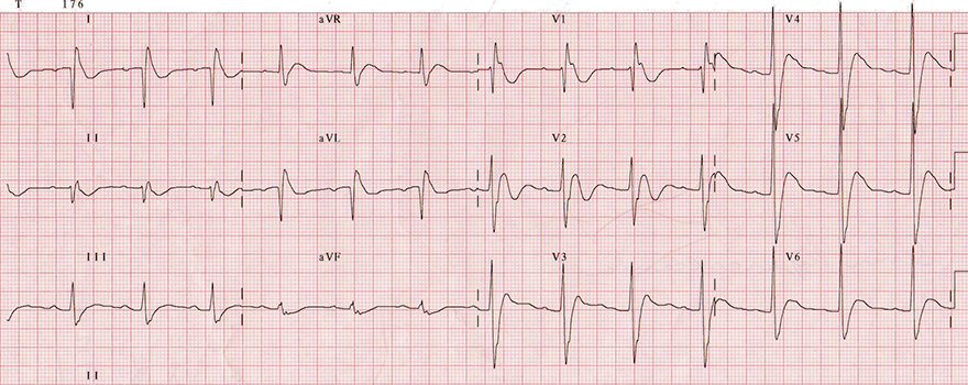 ECG hypercalcemia, high calcium level 6,1mmol/l, short QT interval, J - Osborn wave with notch