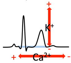 Hypercalcemia - ECG book