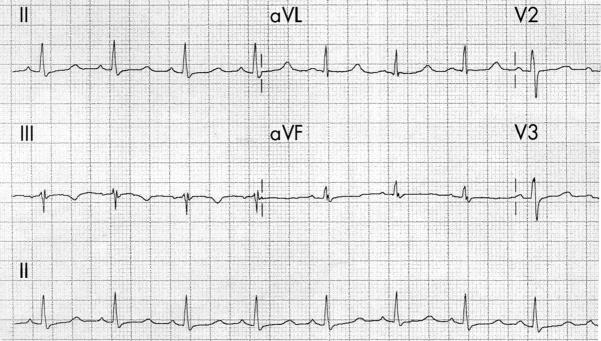 ECG low calcium, hypocalcemia 1,32mmol/l, long QT interval, sinus rhythm