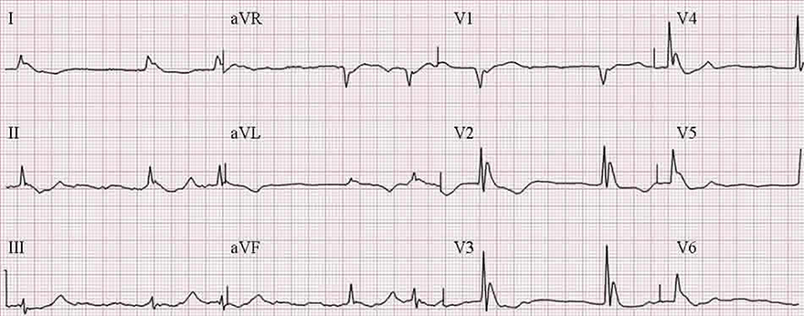 ECG hypothermic J wave, hypothermia 29 degree