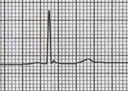 ECG hypothermic wave, J wave, Osborn wave, hypothermia 32 degrees Celsius