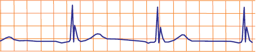 ECG J wave (Osborn) and hypothermia 35 degrees Celsius