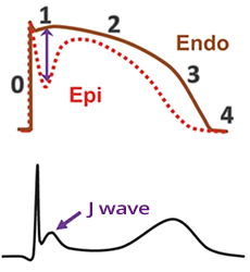 ECG J wave mechanism action potential endocardium, epicardium