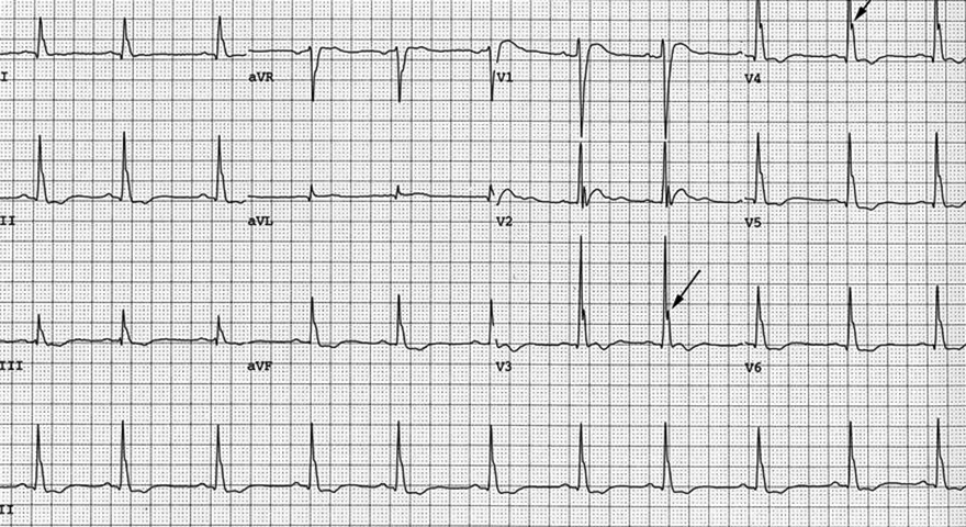ECG J wave - notch, and hypercalcaemia