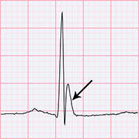 ECG J wave, Osborn wave, camel-hump sign, late delta wave, hathook junction, hypothermic wave, K wave, H wave or current of injury