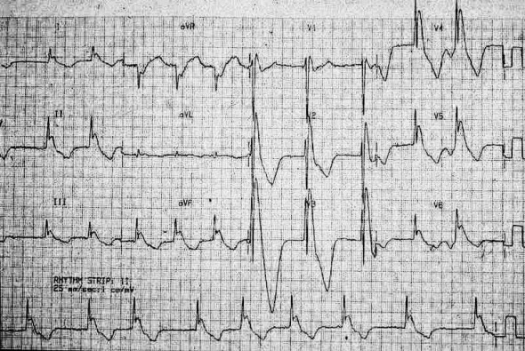 ECG hypothermia and J wave, Osborn wave 27 degrees Celsius