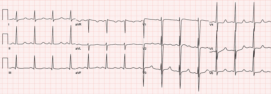 ECG prolongation QT interval, hypocalcemia