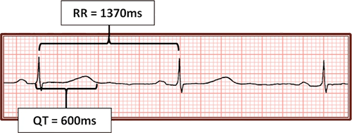 ECG long QT interval